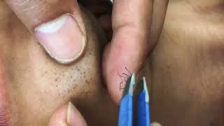 ASMR ingrown Facial hairs removal for mr Pwmavsfkwywpamgafyqo ASMR [upl. by Devlin869]