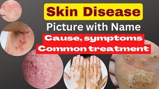 skin disease picture with name  skin problem with namecause symptoms common treatment nsgcare [upl. by Fuchs]