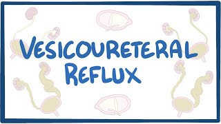 Vesicoureteral reflux  causes symptoms diagnosis treatment pathology [upl. by Yatnoed]