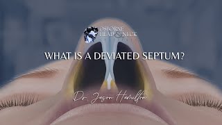 What is a deviated septum [upl. by Stephie]