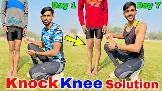 Knock knee कैसे ठीक करें  Knock knee problem solution  knock knees best exercise and tips in hindi [upl. by Akalam]