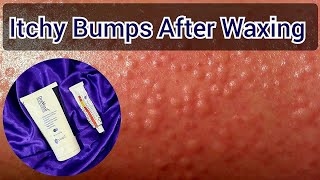 Rashes After Waxing  How To Get Rid Of Itching amp Small Bumps After Wax [upl. by Nirrek737]