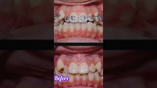 Orthodontic treatment braces orthodontics brackets [upl. by Penthea600]