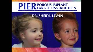 Dr Sheryl Lewins Lecture on Porous Implant Ear Reconstruction  LAMAC 2017 [upl. by Hsenid]