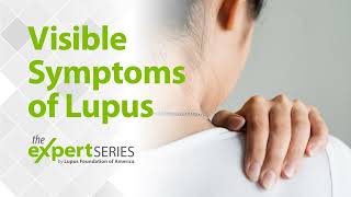 The Expert Series S6E2 Visible Symptoms of Lupus [upl. by Tallbott]