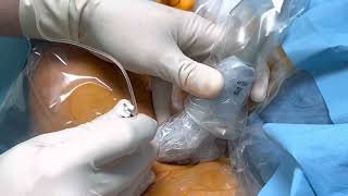 Adductor Canal Block  Saphenous nerve Block [upl. by Kristy]