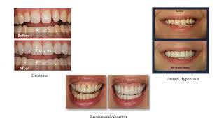 Dept Of Prosthodontics Lec1 Introduction To Fixed Partial Denture [upl. by Birdie]