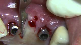 CV77 Free Gingival Harvest and Uncovering of Two Anterior Implants PREVIEW [upl. by Anelrahc]