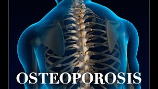 Osteoporosis in Thalassemia Early Symptoms Causes Treatments Prevention and More [upl. by Akirre]