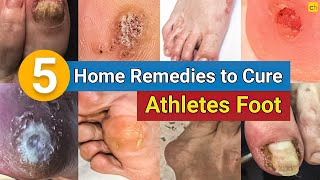 5 Home Remedies to Cure Your Athletes Foot Permanently  Credihealth infection homeremedies [upl. by Obocaj]