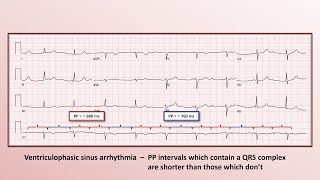 Advanced EKG  10 Miscellaneous Diagnoses [upl. by Otanutrof86]