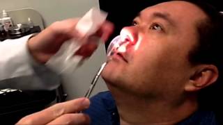 Doyle splint removal after sinus surgery [upl. by Somisareg]