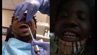 YFN Lucci Takes His Diamond Teeth Out Shows His True Baby Shark Teeth [upl. by Hezekiah]