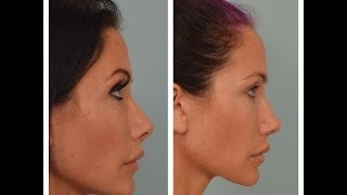 UPDATED Rhinoplasty Advice From Patient Nose Job Questions [upl. by Emelina]