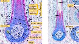 Infundibular keratinizing acanthoma [upl. by Shannen]