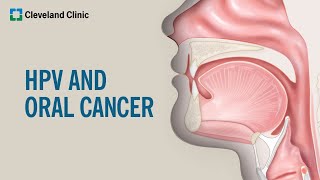 What Is HPVRelated Oral Cancer [upl. by Solberg]