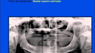 TEMA 10 el paciente totalmente desdentado [upl. by Ul]