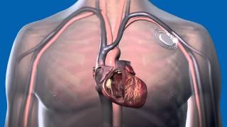 What Is a Pacemaker and How Does It Work [upl. by Sokim]