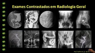 Exames Contrastados  Urografia Excretora aula 1 [upl. by Zelde]