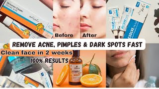 REMOVE ACNE PIMPLES AND DARK SPOTS FAST [upl. by Avis540]