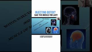 Injecting Botox Save THIS Muscle for Last [upl. by Balduin]