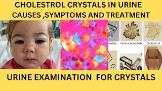 CHOLESTROL CRYSTAL IN URINECAUSES SYMPTOMS AND TREATMENT OF CHOLESTROL CRYSTALS URINARY CRYSTAL [upl. by Linden469]