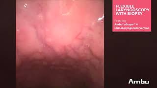 Flexible Laryngoscopy with Biopsy Vore [upl. by Avrom543]