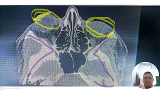 tomografía de orbitas [upl. by Sukramal]