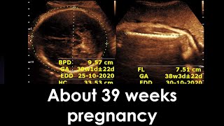 Practical ultrasound case  About 39 weeks pregnancy [upl. by Croft]