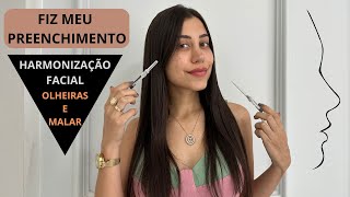 FIZ MEU PREENCHIMENTO SOZINHA  OLHEIRAS E MALAR  HARMONIZAÇÃO FACIAL [upl. by Wirth]