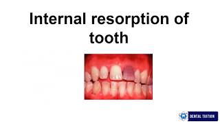 Internal Resorption  Conservative and Endodontics Exam notes [upl. by Deny]