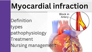 Myocardial infraction for nursingTypes of Mi TreatmentNursing diagnosisshot [upl. by Boeke]