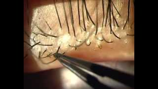 Demodex Blepharitis  Is it for real [upl. by Katerina]