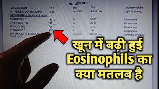 Eosinophils high in blood test means eosinophilia High Eosinophils cbc Blood test in hindi [upl. by Ociram]