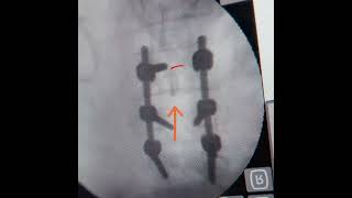 AP projection evaluation after transpedicular screw deployment [upl. by Hulbert653]