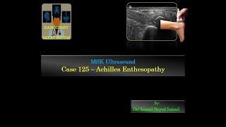 Ultrasound Case 125  Achilles Enthesopathy [upl. by Lozano]