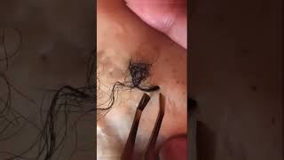 Removal of ingrown hair [upl. by Onibas]