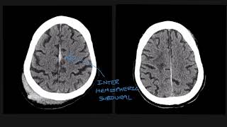 Understanding the different types of traumatic brain bleed on CT scans [upl. by Ervine]