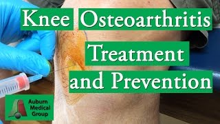 Knee Osteoarthritis Treatment and Prevention  Auburn Medical Group [upl. by Skye]