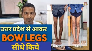 YOUNG BOY FIXED BOW LEGS IN VERY LESS TIME in 55 days complete recovery [upl. by Emina]