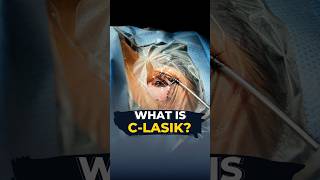 Do You Know What Is CLasik I CLasik Live Surgery [upl. by Nerahs]