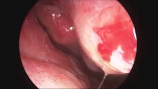 Turbinoplastica mininvasiva in endoscopia con radiofrequenza [upl. by Topping365]