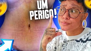 QUEM FEZ ABDOMINOPLASTIA PODE COLOCAR PIERCING NO UMBIGO [upl. by Eeniffar]