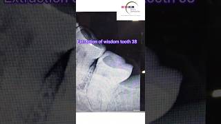 Painless EXTRACTION of Wisdom Tooth bhatiadentopulse toothpain extraction [upl. by Arty583]