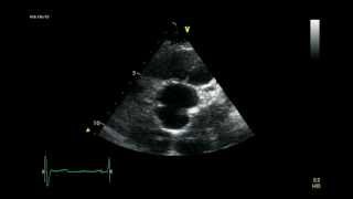 AORTIC BICUSPID VALVE ECHOCARDIOGRAM [upl. by Gillespie402]