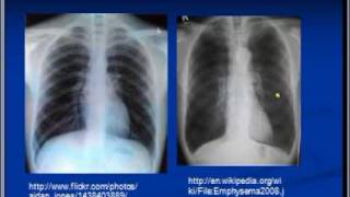 Chest xray interpretation COPD and Emphysema [upl. by Bobker556]