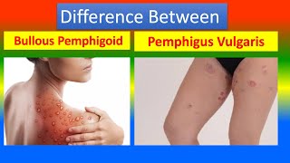 Difference Between Bullous Pemphigoid and Pemphigus Vulgaris [upl. by Teahan637]