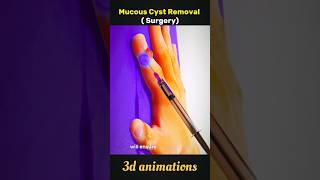 Mucous Cysts Removal Surgery shorts hand cysts removal surgery [upl. by Yelda160]