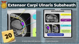 KORAnatomy20 Extensor carpi ulnaris ECU subsheath complex Linea Jugata [upl. by Nagiam61]