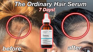 I Used The Ordinary Hair Serum For A WEEK amp This Happened…  Before amp After [upl. by Byram254]